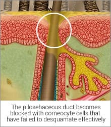 blocked-pilio-duct IAC - International Association for Applied Corneotherapy blocked pilio duct