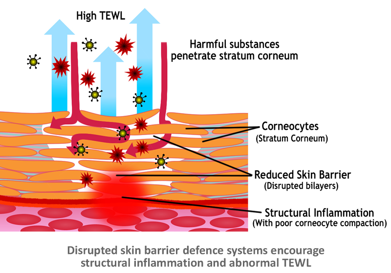 disrupted-bilayer-web-22 IAC - International Association for Applied Corneotherapy Disrupted skin barrier